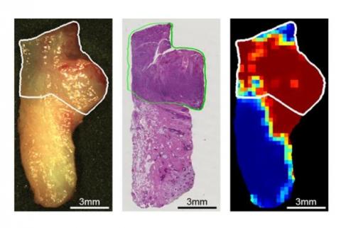 Repérage de la tumeur par imagerie hyperspectrale et intelligence artificielle (à droite) vs méthodes de microscopie actuelles (au centre) 