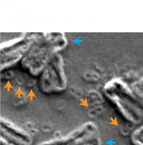 Ce phénomène connu sous le nom de « chromothripsie » est caractérisé par une rupture des chromosomes (flèches bleues sur schéma) et une circulation d'ADN extra-chromosomique (ADNc) (flèches orange)(Visuel Paul Mischel, UC San Diego)