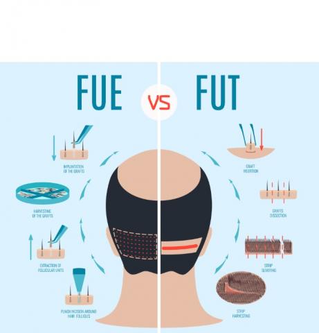 Plusieurs études ont documenté la technique FUE comme « le dernier progrès technique » en matière de restauration chirurgicale des cheveux.