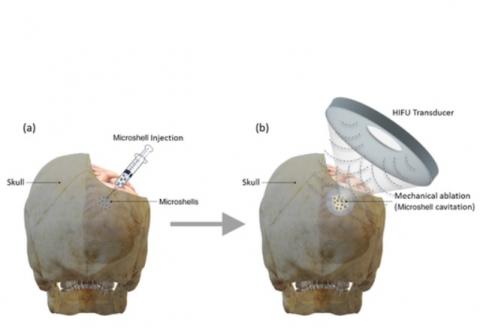 En modulant les ultrasons à haute fréquence, les chercheurs sont capables de créer différentes températures sous lesquelles les cellules cancéreuses se rompent. 