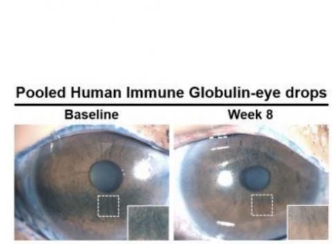 Les patients traités avec des gouttes oculaires à base d'anticorps bénéficient d’une réduction du nombre de zones sèches ou lésions cornéennes
