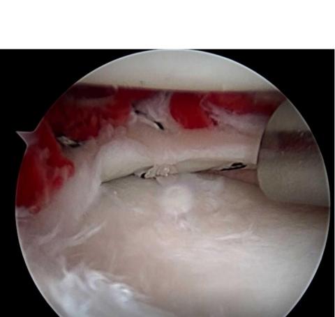 Vue arthroscopique après implantation du caillot de fibrine dérivé de la moelle osseuse et réparation du ménisque du genou droit (Visuel H. Nakamura & Y. Hashimoto, Orthopedics, Osaka City University) 
