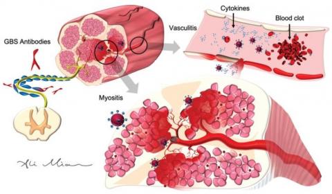 Le virus déclenche une cascade inflammatoire ou « tempête de cytokines », qui commence dans les poumons, se propage dans les vaisseaux sanguins et dans tous les organes du corps. Cette tempête de cytokines conduit à la formation de caillots sanguins qui provoquent des AVC dans le cerveau. (Journal of Alzheimer's Disease)