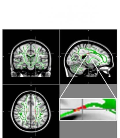 Ces réductions de FA sont identifiées principalement dans le corps calleux, un faisceau de fibres nerveuses qui relie les hémisphères gauche et droit du cerveau, dans le gyrus orbitofrontal moyen, une région du cerveau impliquée dans le contrôle des émotions et dans le circuit de récompense. Ces réductions de FA sont identifiées principalement dans le corps calleux, un faisceau de fibres nerveuses qui relie les hémisphères gauche et droit du cerveau, dans le gyrus orbitofrontal moyen, une région du cerveau impliquée dans le contrôle des émotions et dans le circuit de récompense.