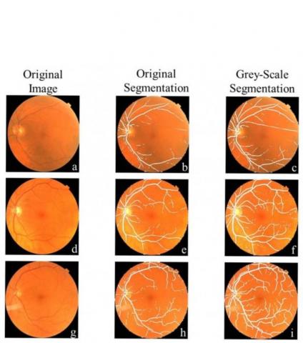 Le système d'apprentissage automatique a été programmé à l’aide d’images de l'arrière de l'œil de patients atteints de la maladie de Parkinson et de participants témoins (Radiological Society of North America)