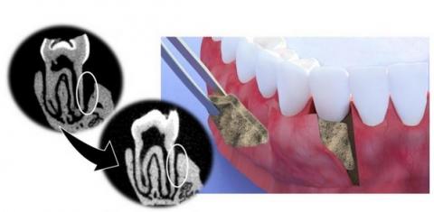 Le revêtement accélère la régénération osseuse en favorisant la minéralisation de l’hydroxyapatite, le minéral constituant l’émail des dents et les os