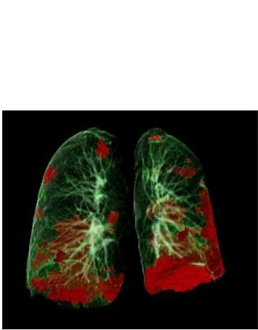 Tomodensitométrie d’un patient COVID-19 montrant les dommages aux poumons en rouge (Visuel Gerlig Widmann and team, Department of Radiology, Medical University of Innsbruck)
