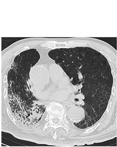 Les consolidations pulmonaires ou zones hypoéchogènes ressemblant à des tissus, reflétant un débit d'air très réduit et une quantité accrue d'exsudat cellulaire inflammatoire sont plus fréquemment rencontrées dans les cas graves et critiques