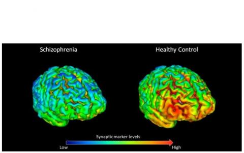 Les participants en bonne santé ont, en moyenne des niveaux plus élevés (en jaune-rouge sur visuel) de protéine « de synapse » SV2A que les patients atteints  (à gauche). 