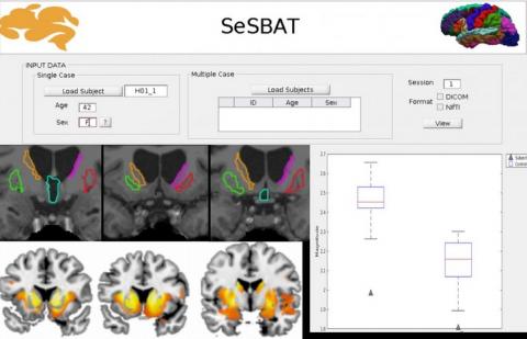 Un programme informatique nommé SeSBAT ​​pour Single Subject Brain Analysis Toolbox