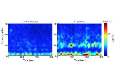 Chez la plupart des participants, de fortes oscillations (entre 4 et 12 Hz) dans le cervelet. Or ces oscillations ne sont pas présentes chez les 20 témoins exempts de tremblements