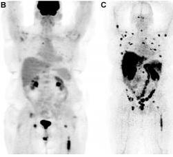 CANCER de la PROSTATE: Le nouvel agent d'imagerie qui identifie ...