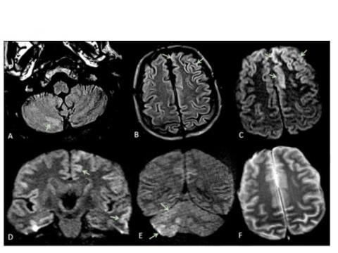 L'étude montre que ces complications neurologiques peuvent inclure plusieurs types d’encéphalopathie dont le syndrome d'encéphalopathie réversible postérieure (avec anomalies radiologiques cérébrales bilatérales réversibles- voir visuel ci-contre), l'encéphalopathie hypoxique ischémique ou encore une exacerbation de la maladie démyélinisante.