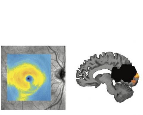 Ce visuel montre une dégénérescence de l'œil (visible sur le coin inférieur droit) après un AVC dans la zone de traitement visuel du cerveau (en noir sur visuel de droite).