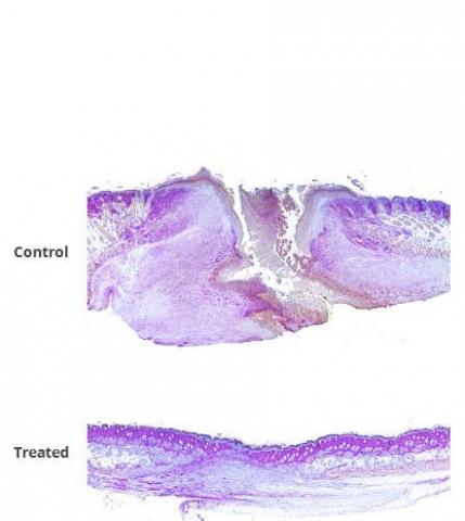 En réduisant les niveaux de FL2 dans les cellules de la peau, le FL2-siARNs aide les cellules à recouvrir et combler le site de la plaie beaucoup plus rapidement qu'elles ne le feraient normalement.