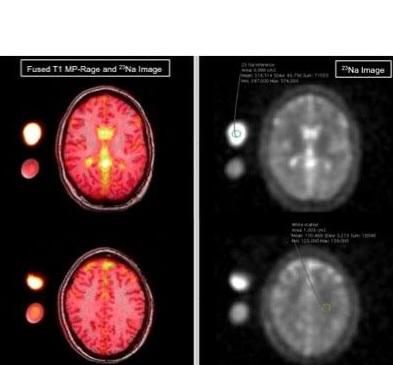 Les concentrations en sodium des patientes migraineuses sont plus élevées dans le liquide céphalorachidien Les concentrations en sodium des patientes migraineuses sont plus élevées dans le liquide céphalorachidien