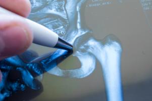 La chirurgie assistée par robot n'affecte pas ou n’accroît pas le risque d'infection après une arthroplastie de la hanche (Visuel Adobe Stock 146660430)