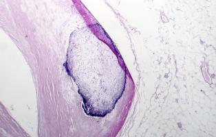 L'étude souligne ainsi l’importance d’une détection précoce de l’athérosclérose, même à niveau subclinique, pour le suivi de la santé globale (Visuel Adobe Stock 212636155).