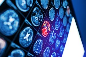 L'âge du cerveau, tel qu’évalué par neuroimagerie, joue un rôle déterminant dans les résultats post-AVC et onstitue un marqueur fiable pour identifier les patients à risque de moins bons résultats (Visuel Adobe Stock 220113313)