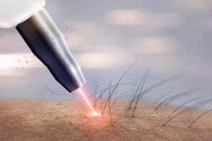 L'épilation au laser se révèle une intervention complémentaire efficace pour réduire le risque de récidive de la maladie pilonidale (Adobe Stock 228791336).