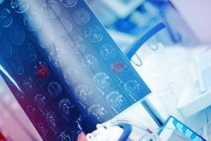 Les bloqueurs des récepteurs de l'angiotensine (BRA), des médicaments indiqués contre l’hypertension artérielle (HTA) pourraient prévenir les crises d’épilepsie (Visuel Adobe Stock 228893665)