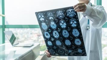 50 millions de personnes dans le monde sont atteintes de différentes formes de démences, dont la maladie d’Alzheimer, et cette prévalence pourrait atteindre 152 millions de cas en 2050 (Visuel Adobe Stock 296940799)