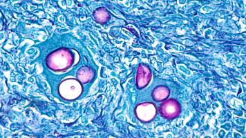 Que pourrait nous apprendre le cancer sur la tuberculose ? (Visuel Adobe Stock 333721267)