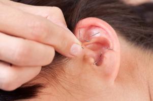 L’acupuncture, par stimulation sur 6 points de l'oreille externe avec de simples perles métalliques aide à réduire le tour de taille, la graisse corporelle et l'IMC chez des participants souffrant d'obésité (Visuel Adobe Stock 36571781)