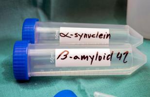 Le mauvais repliement de la protéine Alpha-synucléine toxique pourrait se lire dans les fluides corporels, précisément à ce stade dans le dans le liquide céphalorachidien (LCR) plus de 15 années avant l’apparition de la maladie de Parkinson (Visuel Adobe Stock 380627309)