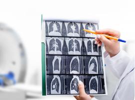 Pourquoi les personnes atteintes de maladie pulmonaire obstructive chronique (MPOC) sont plus vulnérables aux formes sévères de COVID-19 (Visuel Adobe Stock 390810564)