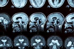 L'autisme n'est pas lié à un déclin cognitif accru avec l'âge (Visuel Adobe Stock 428612018)