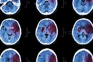 Traiter ou bloquer l’inflammation du cerveau pourrait retarder la progression de la maladie (Visuel Adobe Stock 95363129)