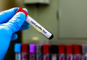 La qualité du cholestérol HDL et non sa quantité, peut contribuer à l’apparition de la maladie d’Alzheimer chez les femmes (Visuel Adobe Stock 962976963)