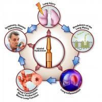 L'inhalation de hyaluronane interfère à presque toutes les étapes du cycle de la maladie pulmonaire (Voir visuel), ce qui en fait un traitement puissant pour les maladies pulmonaires chroniques (Visuel Stavros Garantziotis, M.D.). 