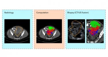 Cette technique d’échantillonnage de précision à base d’imagerie de base évite aux patients trop de procédures invasives et marque une étape importante dans une prise en charge mieux personnalisée et moins stressante des patients (Visuel Evis Sala/University of Cambridge)