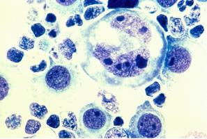 La chimio fait parfois des cellules « monstres » (Visuel NIH)