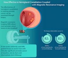 Ici, une élimination de la tumeur est constatée par biopsie chez 82% des participants ayant subi ce mode de cryoablation (HGCryo) (Visuel UCLA)