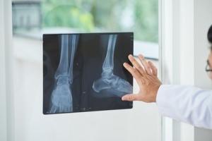 Les fractures ont un impact à long terme sur la qualité de vie des personnes âgées