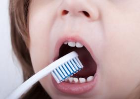 Le symptôme des « dents crayeuses » est caractérisé par une hypominéralisation et un défaut du développement de l'émail dentaire. 