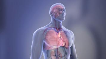 Plus de 40% des adultes sans maladie cardiaque connue présentent des dépôts graisseux dans les artères, ce qui suggère un certain degré d'athérosclérose et un risque accru de maladie et d’événement cardiovasculaire (Visuel AHA)