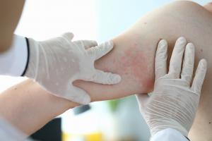 Les maladies inflammatoires chroniques de la peau telles que dermatite atopique et le psoriasis sont caractérisées par la présence de sous-types de cellules T activées, qui sécrètent des cytokines pro-inflammatoires dans la peau (Visuel adobe stock 321863066).