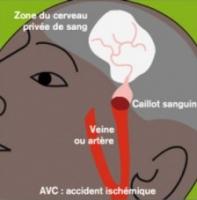 C’est un nouvel avertissement sur les conséquences de l’obésité à l'adolescence, cette fois sur la santé cérébrovasculaire, avec précisément un risque accru d'accident vasculaire cérébral (AVC) associé, à l'âge adulte (Visuel NIH)