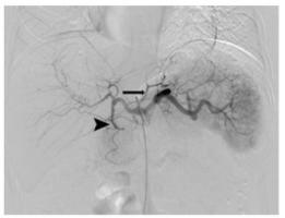 L’embolisation gastrique ou bariatrique, une procédure moins invasive, qui consiste à injecter des billes microscopiques sous contrôle d'imagerie dans l'artère alimentant l’estomac en sang.