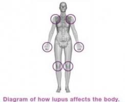 Le lupus touche en majorité des femmes
