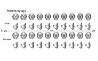 L'analyse faciale en 3D pourrait permettre d’accélérer la détection et le diagnostic des maladies rares chez l’Enfant. (Visuel Genetics in Medicine)