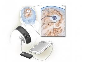 C'est le premier système implanté auto-adaptatif, qui utilise la rétroaction du cerveau lui-même pour affiner sa signalisation.