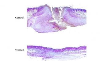 En incorporant un médicament inhibiteur de gènes dans un gel en vente libre, ces chercheurs parviennent à réduire de moitié le temps de cicatrisation