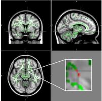 Chez les adolescents obèses, la connectivité est perturbée dans les zones du cerveau impliquées dans la régulation de l'appétit 