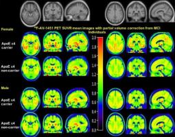 C’est la première étude à démontrer que le sexe module l’effet de l’ApoE ε4 sur le dépôt de tau cérébral