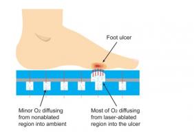 Cette nouvelle semelle pourrait révolutionner le soin de l'ulcère du pied diabétique.